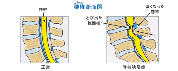 脊柱 管 狭窄 症 治療