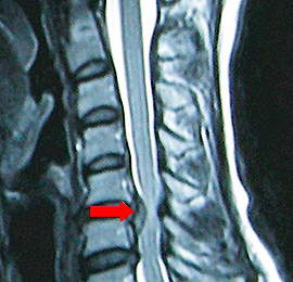椎間板 ヘルニア 頚椎 頚椎椎間板ヘルニアになり半年が経ったのでMRIを再度行うが変化はなかった